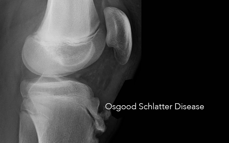 Study Supports Treatment of Osgood Schlatter’s Disease with Prolotherapy