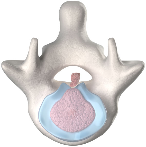 Living With Cervical Spinal Stenosis: My Story - Regenexx