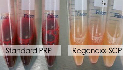 Study Finds PRP outperforms Corticosteroids in mild to moderate knee osteoarthritis
