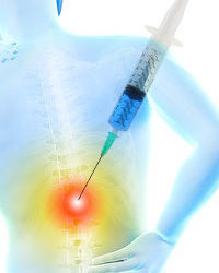Diagnosing Pain with Steroid Injections Before Regenerative Treatments