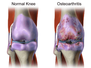 Stem Cell Therapy Can Treat Knee Arthritis